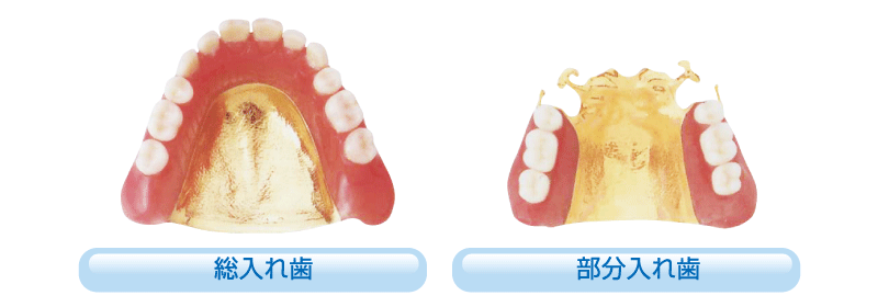 ゴールド床(金・プラチナ)による入れ歯