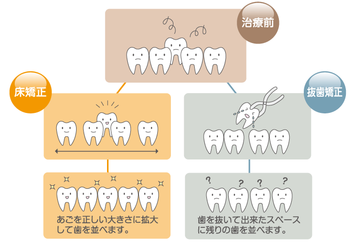 床矯正と抜歯矯正の違い
