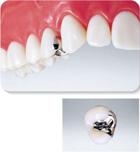 金属のインレー　保険　銀歯　保険適用金属