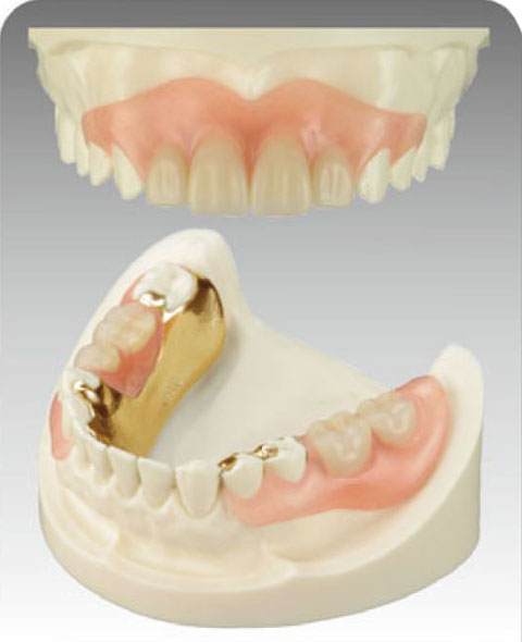 保険外　金属のバネがない入れ歯　(各種金属)+歯科用特殊プラスチック