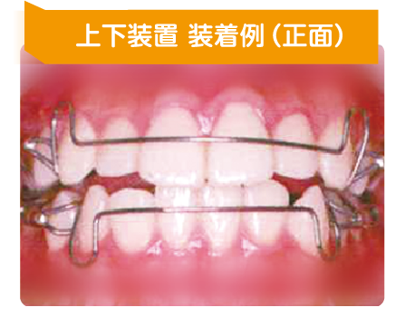 永久歯を抜かずに歯を並べます